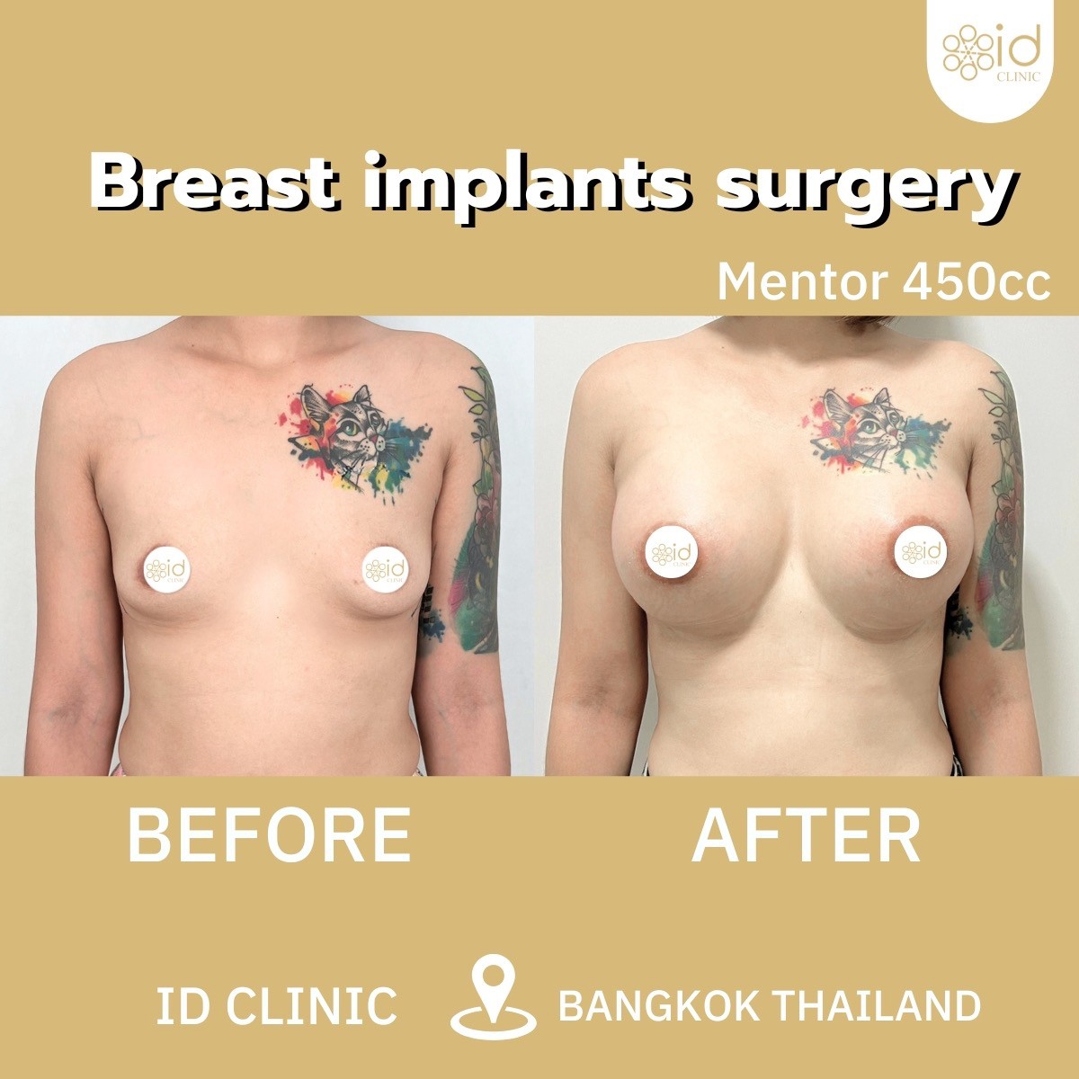 Breast implants Thailand